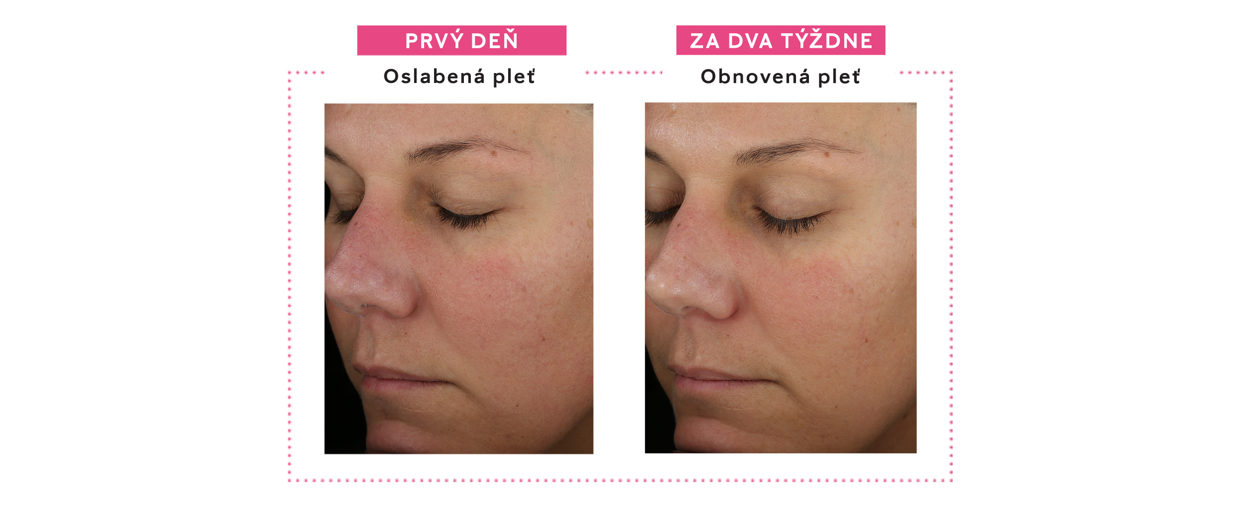 Krém na obnovu kožnej bariéry - pred a po